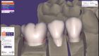 آموزش قرارگیری صحیح دندان (Tooth Placement) در exocad – گام‌به‌گام با حالت‌های Simple، Advanced و Chain در اگزوکد
