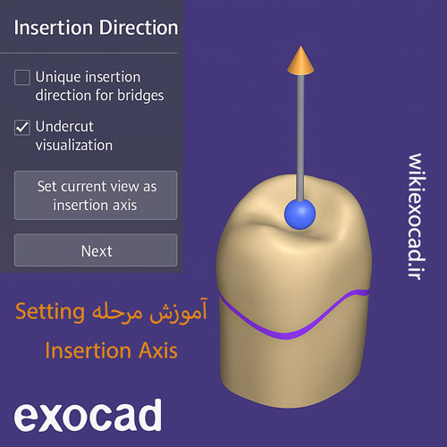 آموزش مرحله Setting Insertion Axis در exocad – تعیین جهت صحیح ورود روکش در اگزوکد 1 حذف شرط: آموزش مرحله Setting Insertion Axis در exocad آموزش مرحله Setting Insertion Axis در exocad