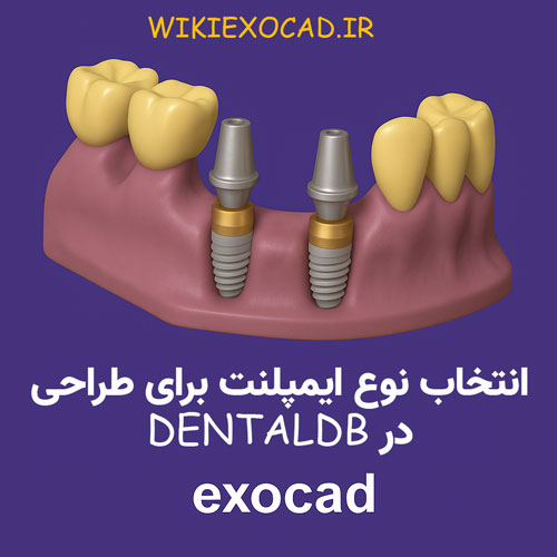 انتخاب نوع ایمپلنت برای طراحی (choose implant type for construction) در DentalDB 1 انتخاب نوع ایمپلنت برای طراحی در DentalDB