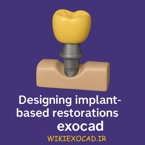 طراحی ترمیم های مبتنی بر ایمپلنت Designing implant-based restorations در اگزوکد - از مدلسازی تا انتخاب کانکشن 1 طراحی ایمپلنت exocad
