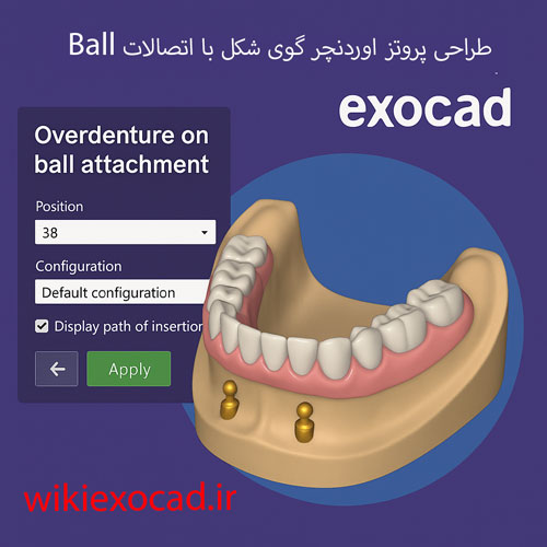 طراحی پروتز اوردنچر گوی شکل (Overdenture on ball attachments) با اتصالات Ball در اگزوکد 1 طراحی پروتز اوردنچر گوی شکل با اتصالات Ball در exocad