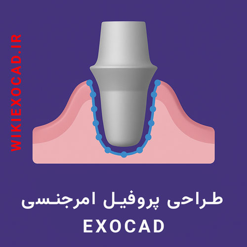 طراحی پروفیل امرجنسی (Emergence Profile) در اگزوکد - تعیین دقیق خط مرزی اباتمنت 1 طراحی پروفیل امرجنسی